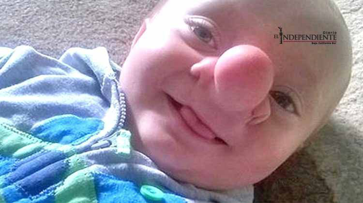 Ollie Trezise, el bebé que tiene parte de su cerebro en la nariz