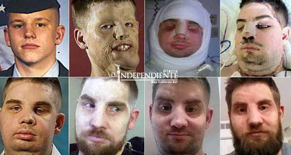 Soldado recibe trasplante de rostro, hoy comparte su historia