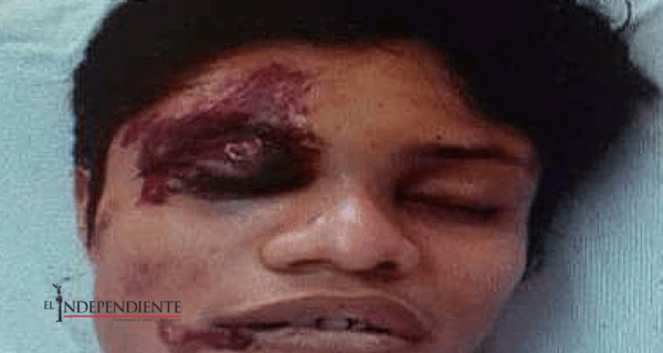 Tras agonia, peatón atropellado muere en el hospital de SJC