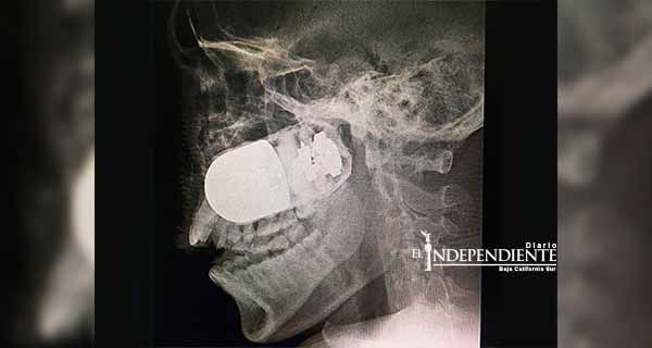 Extraen granada del rostro de un soldado, un caso excepcional