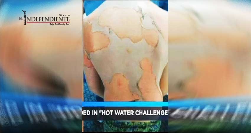El nuevo reto viral que puede matar a tus hijos, ‘Hot water challenge’