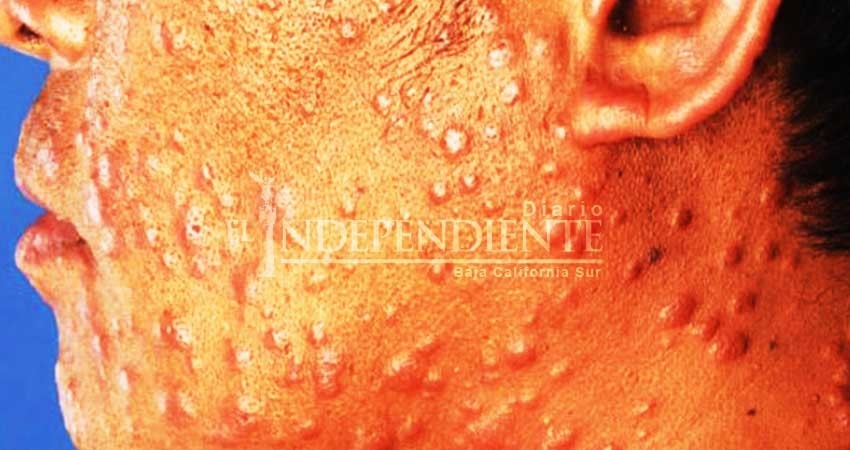 Clínica 6 del IMSS sin casos de lepra