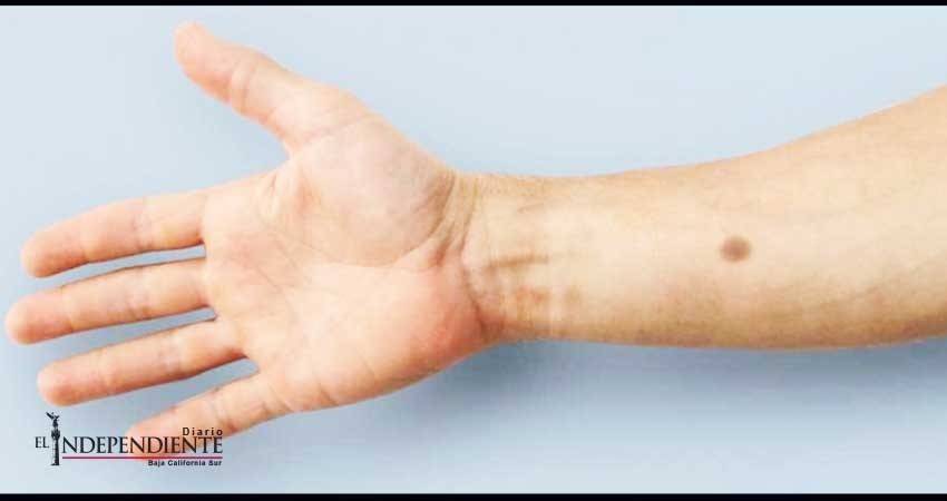 Científicos desarrollan 'lunar artificial' para detectar el cáncer