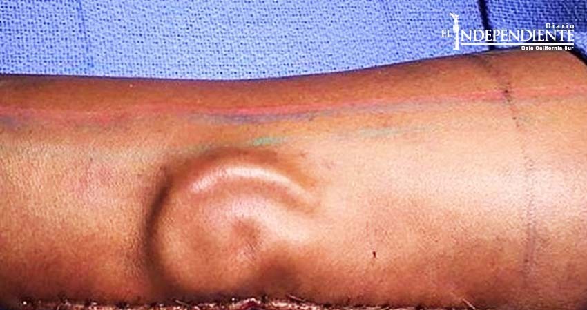 Cirujanos 'crecen' oreja en brazo de mujer soldado en EU