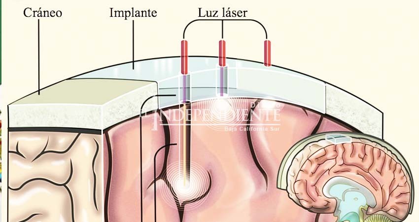 Crean implante craneal que servirá como “ventana al cerebro”