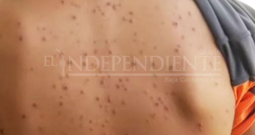 ¡Alerta! Reportan un nuevo brote de varicela en Tijuana