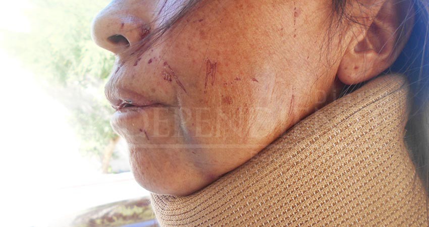 Pide justicia madre de familia que fue golpeada por una pareja en La Ribera 