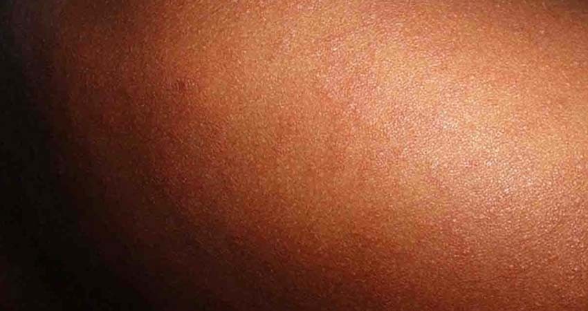 Hay brotes de sarampión en Brasil, Colombia y Venezuela: OPS