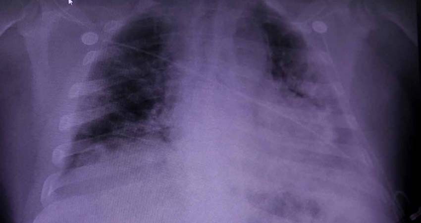 Daño pulmonar por covid-19 puede durar varios meses