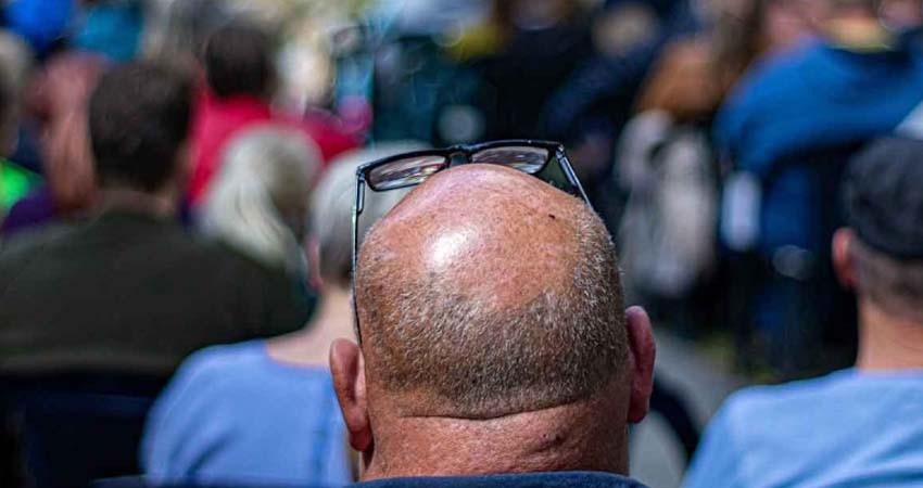 Calvicie estaría relacionada con casos graves de covid, según estudio