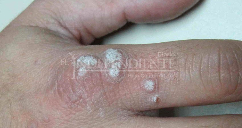 IMSS hace un llamado a la población para prevenir y detectar a tiempo el VPH