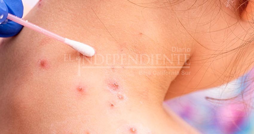 Desde Los Cabos se unen al llamado para apoyar a pacientes con viruela símica