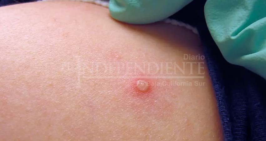 Reporta BCS 4 nuevos casos sospechosos de viruela símica