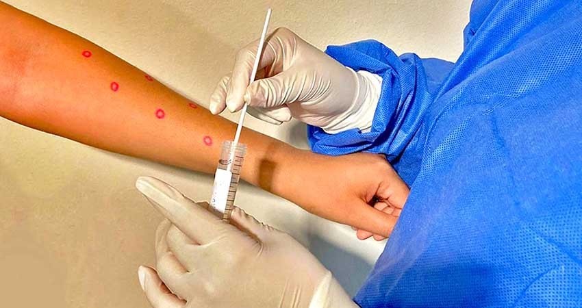 Análisis de laboratorio confirma caso de viruela símica en BCS