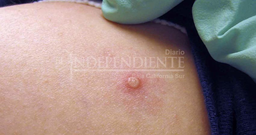 Confirma SSA un nuevo caso de viruela símica en La Paz