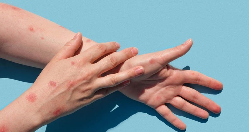 Reporta SSA un nuevo caso de viruela símica en BCS