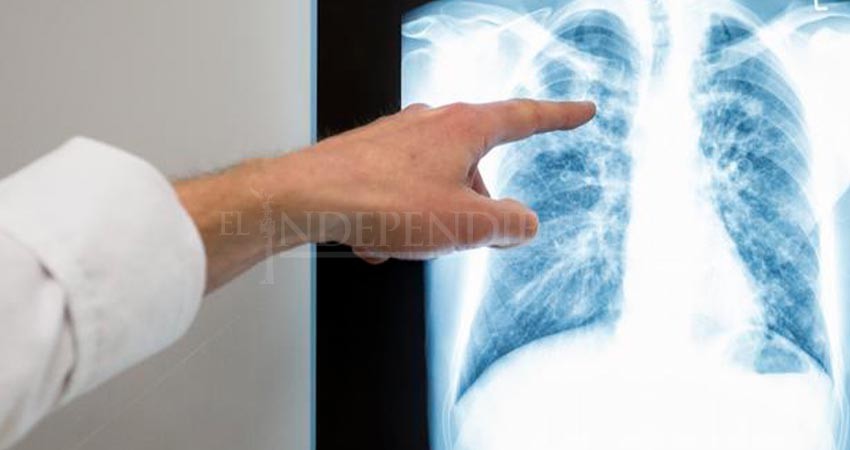 Se han registrado 44 casos de tuberculosis en BCS