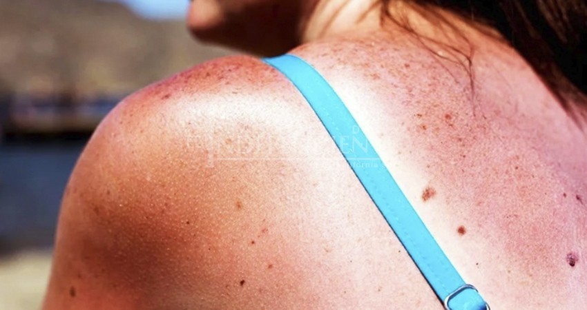 Exposición prolongada al sol puede causar daños irreversibles en la piel