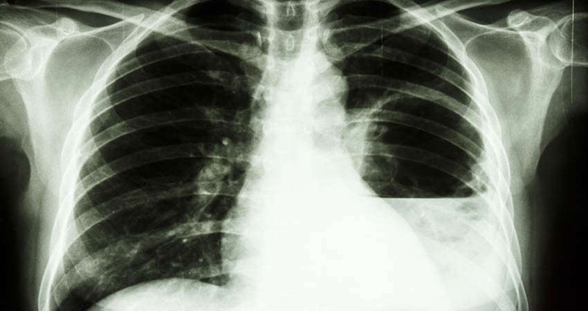 Reporta la SSA 4 muertos por infección de melioidiosis