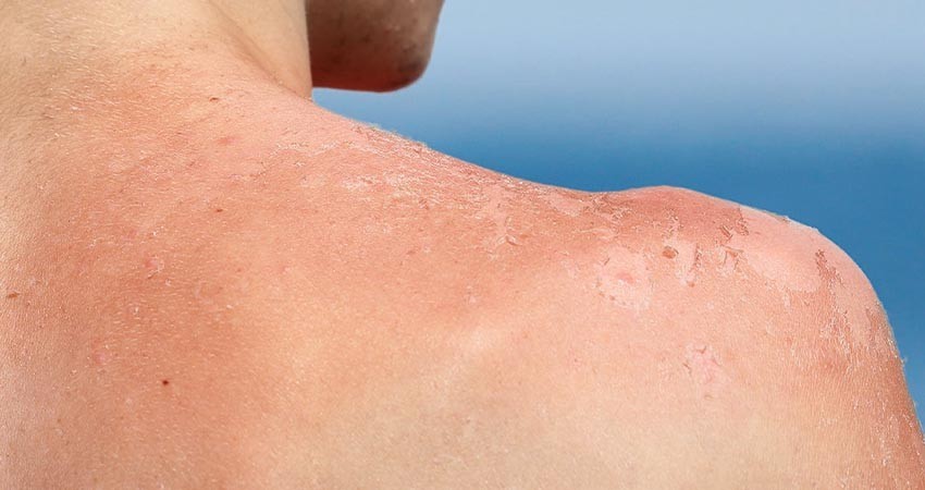 Explican a la población los daños irreversibles en la piel de exponerse al sol