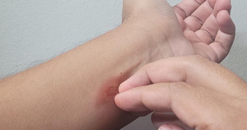 Recomienda a la población protegerse contra la picadura de mosco para prevenir el dengue