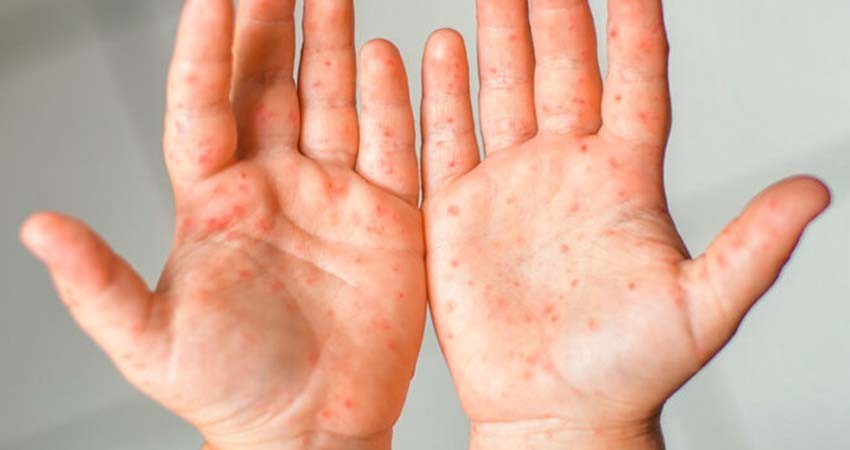 Reforzarán vacunación de sarampión y tos ferina por incremento de casos