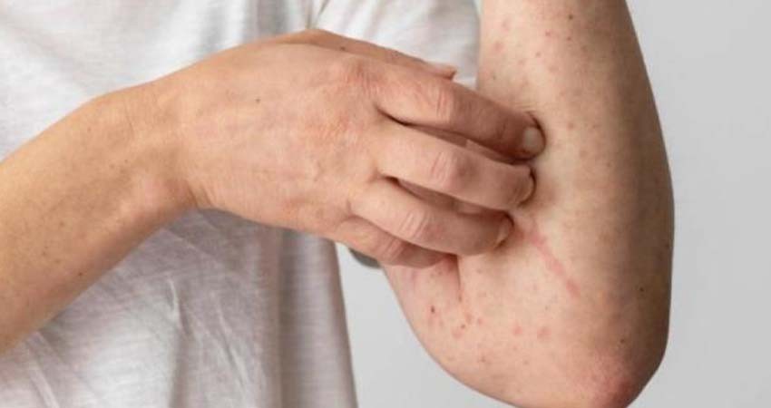 Aumentan casos de sarampión en México; suman 126