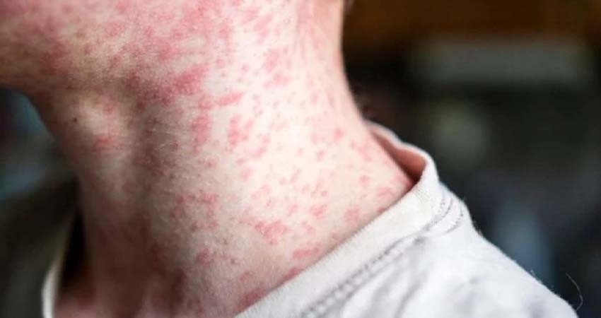 Muere mexicano no vacunado por el actual brote de sarampión