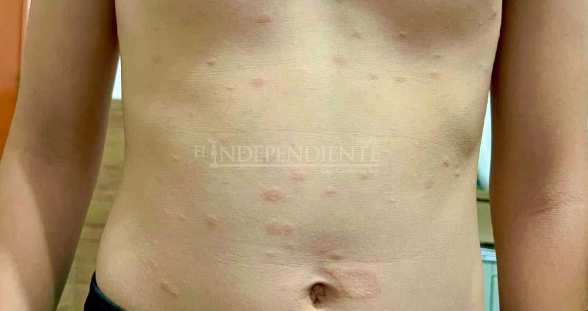 Confirman los primeros 3 casos de sarampión en BCS