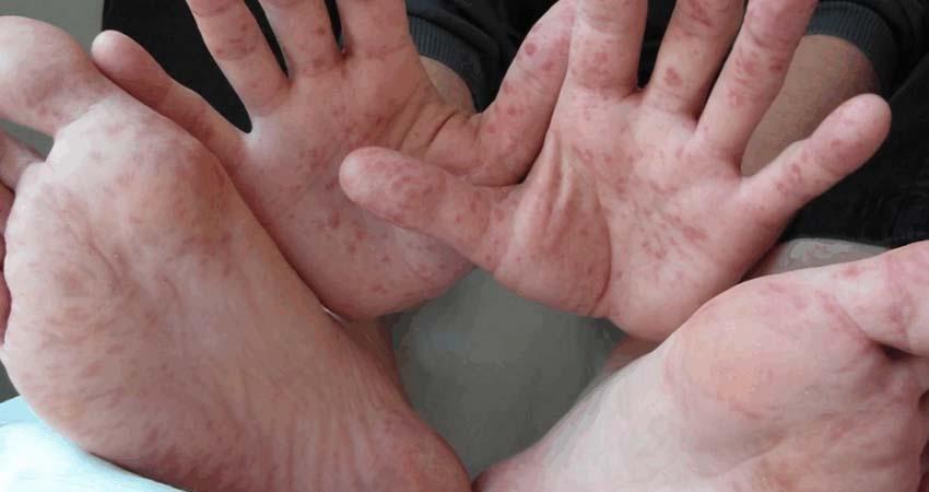 Se extienden casos de coxsackie; registran brotes, al menos, 63 municipios