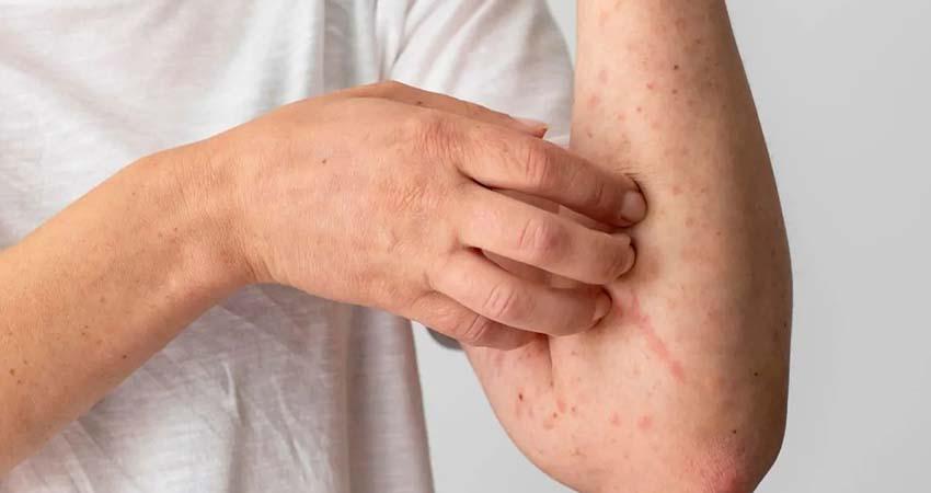 PAN culpa a gobiernos de Morena por brotes de sarampión