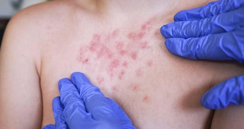 Brote de sarampión en México ya supera los 10,000 casos